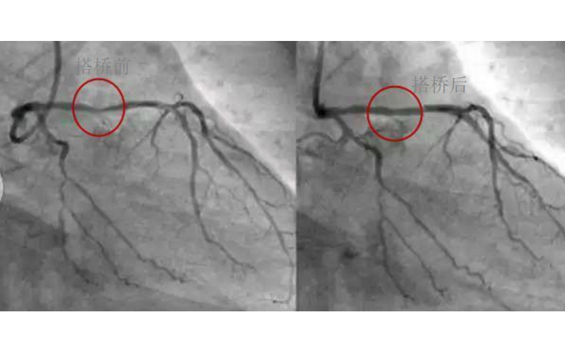 深圳市广发体育网页厂对心脏支架的关注，国产化的道路有多长？